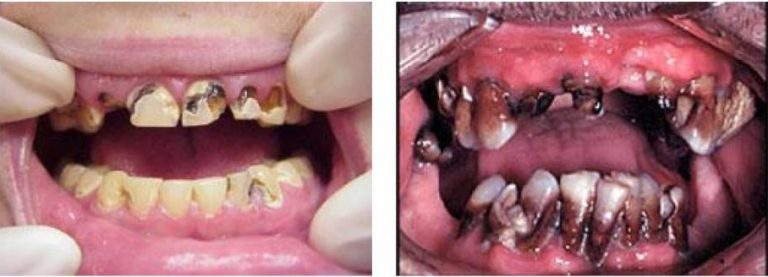 Faces Of Meth Before And After Pictures Modern Network